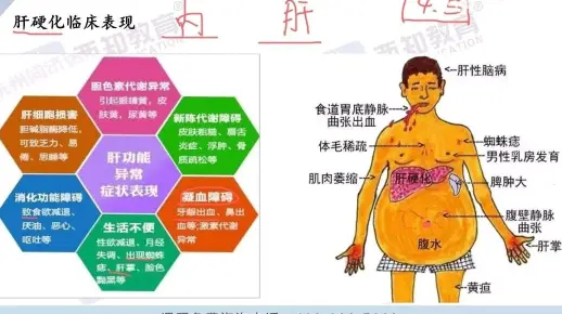 2021年甘肃省基层考试—支医——肝硬化临床表现