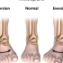 运动损伤康复方案—慢性踝关节不稳（踝关节外侧扭伤、踝关节扭伤）