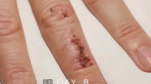 【每日药闻】伤口的愈合