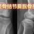 1.胫骨结节撕脱骨折—读片系列-骨肌系统-膝关节