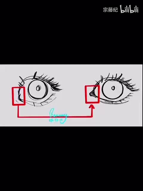 去除内眦赘皮/开眼头