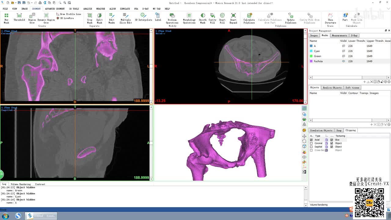 7-2、mimics21蒙版高级骨头分割CT bone)讲解