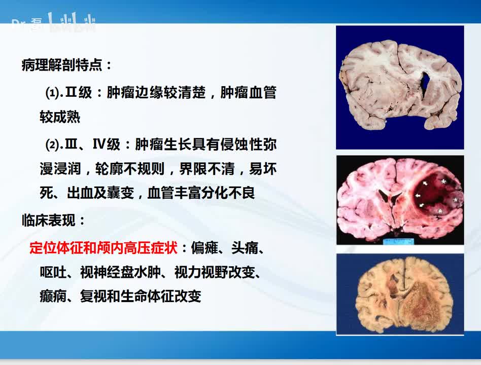 弥漫性星形细胞瘤2