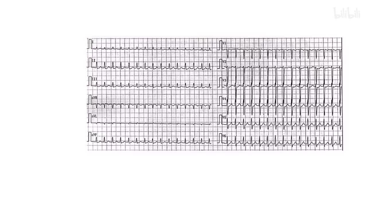 4/8) P波缺如的室上速