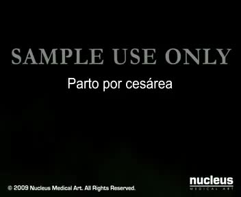 Parto Cesarea运动 35-Parto por Cesárea