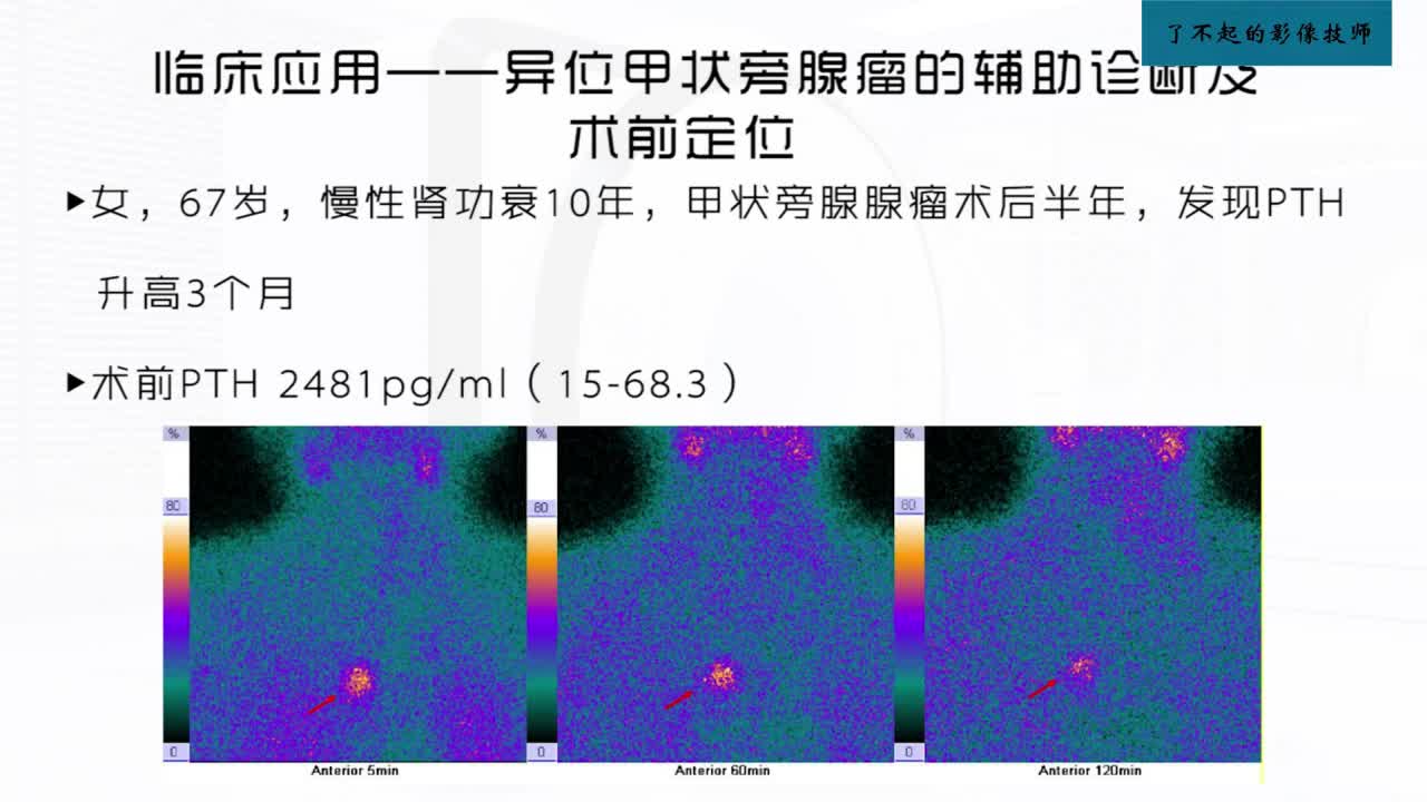 [9.3.1]--9.3 甲状旁腺显像2