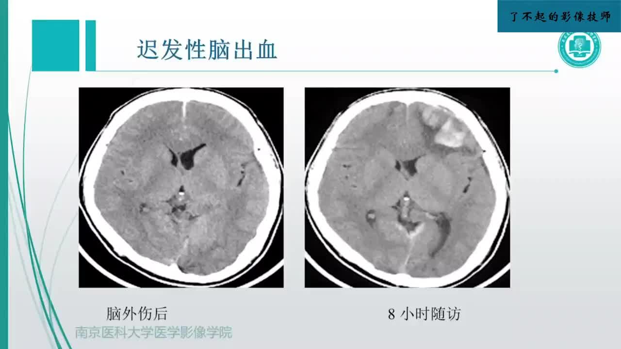 2.6 颅脑外伤影像诊断2