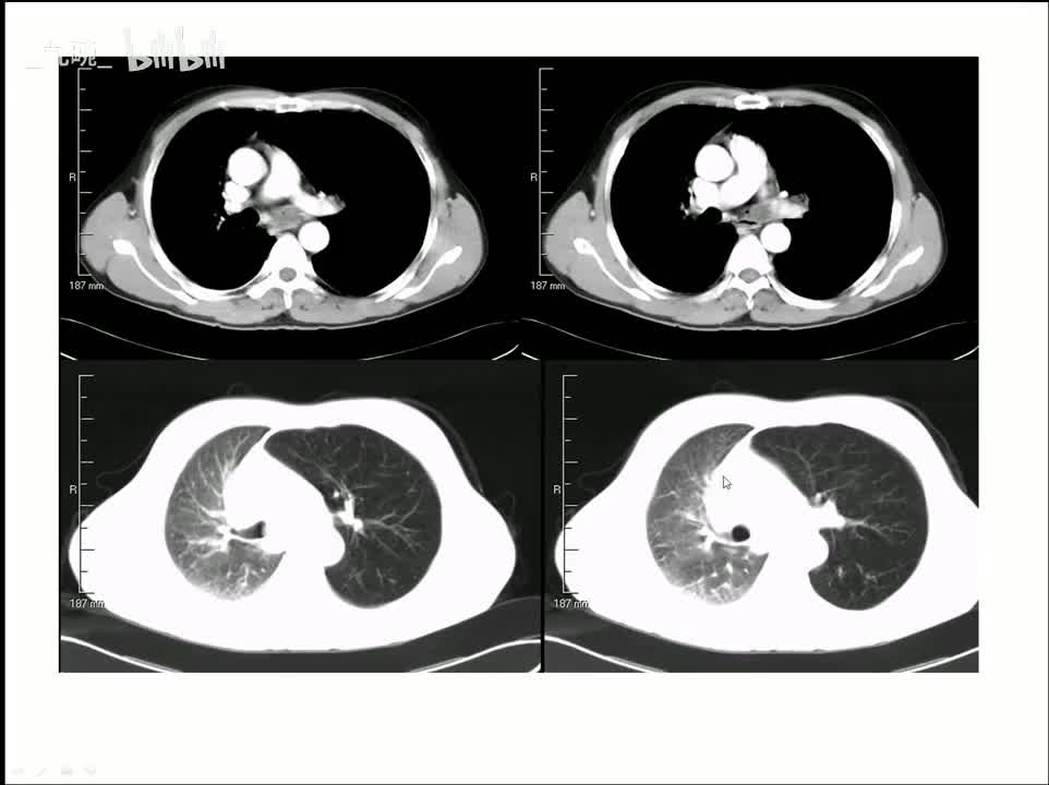 13-呼吸-3-基本病变2
