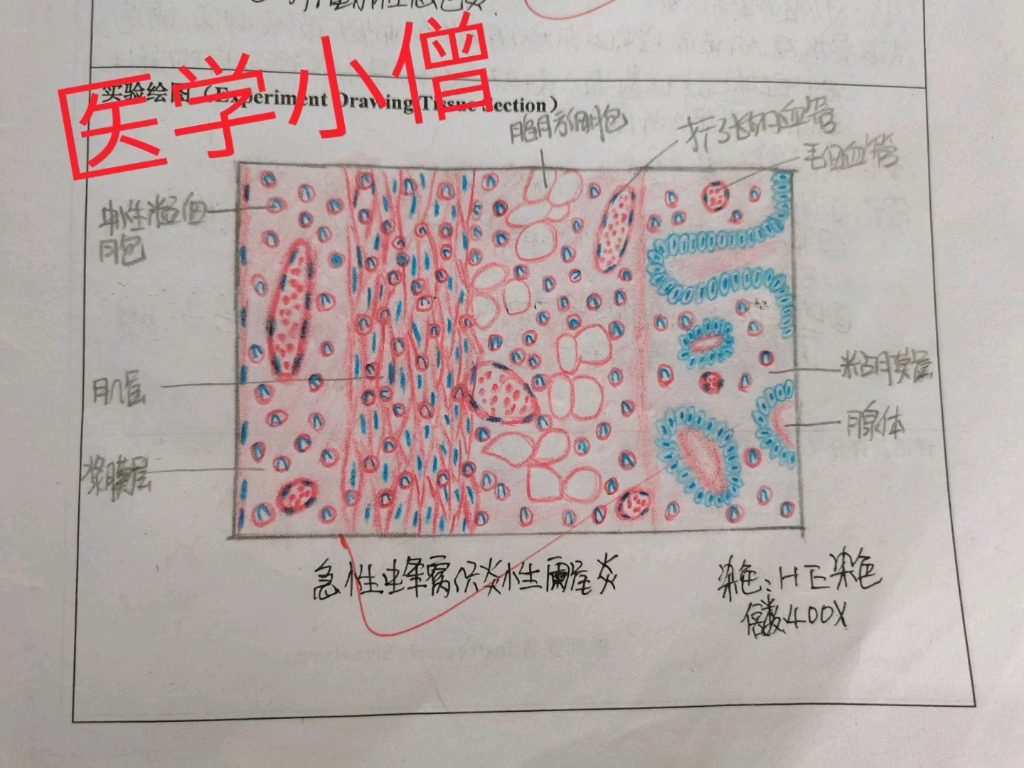 医学小僧之病理手绘篇哔哩哔哩bilibili