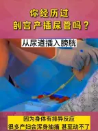 Download Video: 你经历过剖宫产插尿管吗？