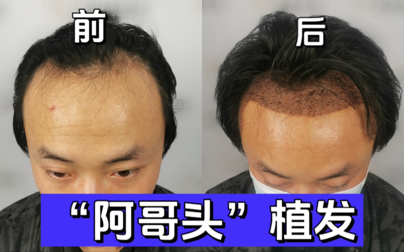 植发额头几厘米(植发还是额头缩小)