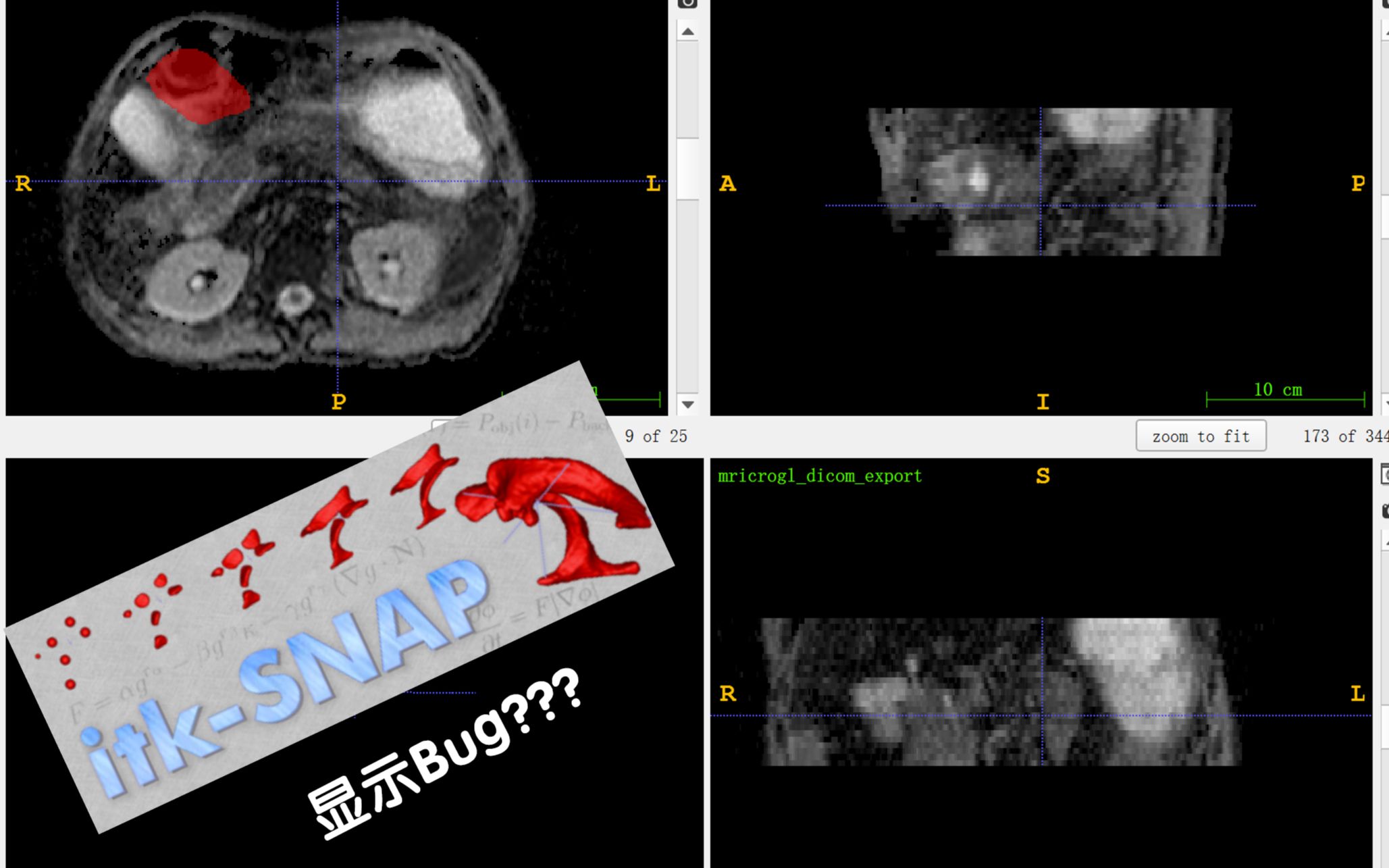 【Suns】ITKSNAP显示ROI错位的"Bug"?哔哩哔哩bilibili