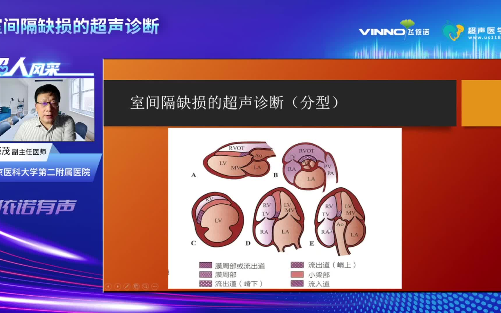 室间隔缺损超声图解图片