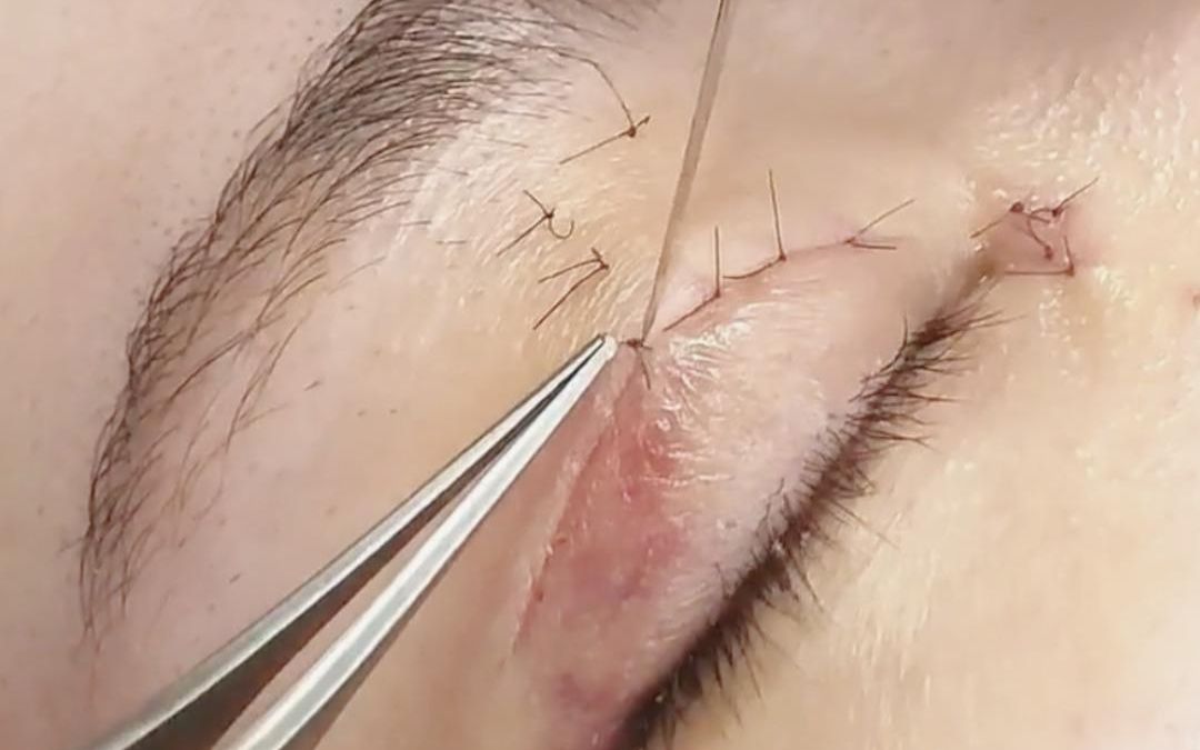 实拍双眼皮七天拆线过程