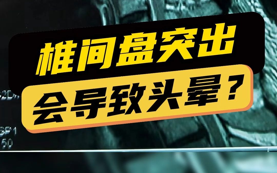 长得这样的颈椎很容易退行性改变、颈椎间盘突出哦!哔哩哔哩bilibili