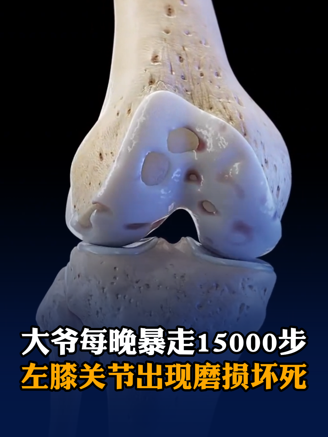 68岁大爷每晚暴走15000步，左膝关节出现磨损坏死
