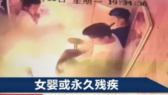 成都一电梯内电瓶车爆燃致女婴烧伤，父亲：她只剩2个完整手指