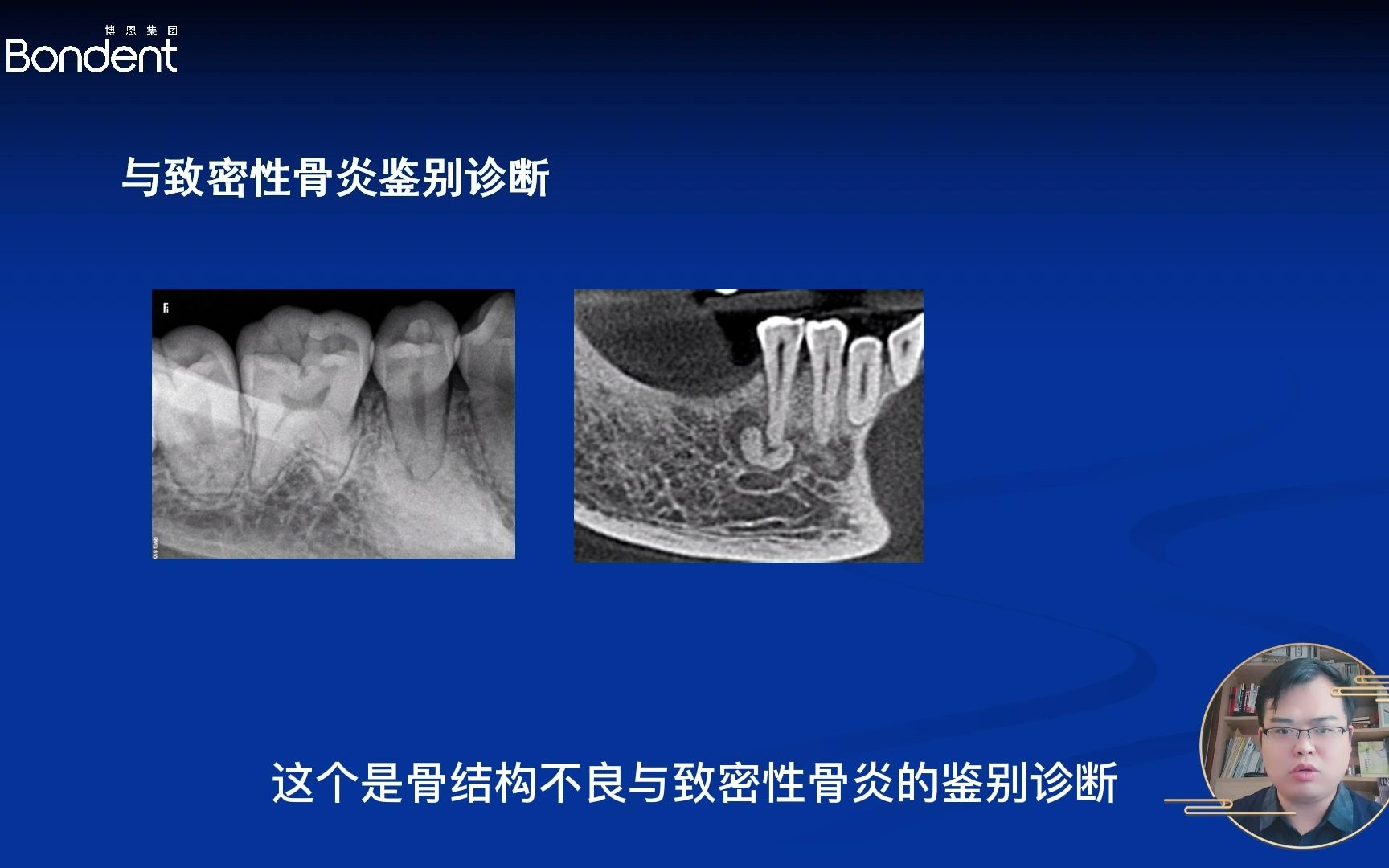 下颌骨致密性骨炎图片图片