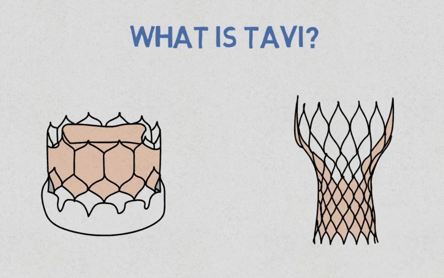 什么是TAVR(TAVI)经导管主动脉瓣介入术哔哩哔哩bilibili