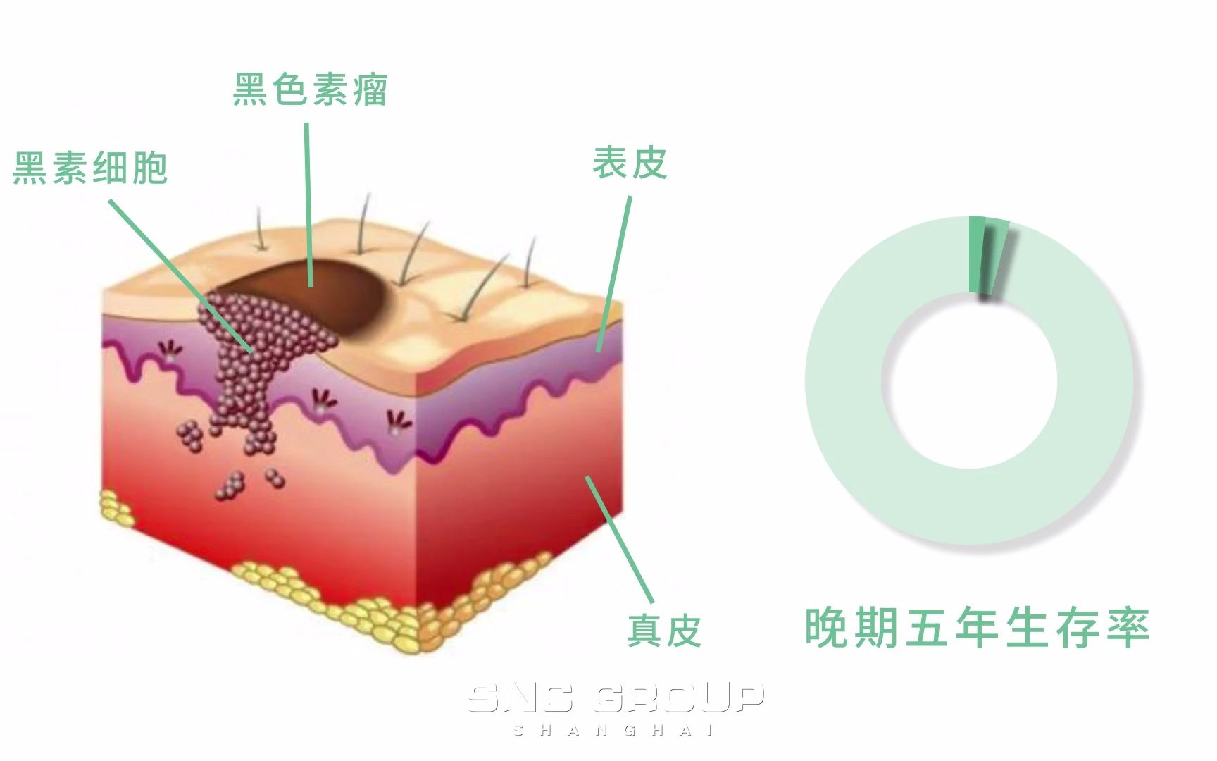 黑色素瘤晚期生存率4%~10%,免疫疗法提高至49%!华夏源细胞存储哔哩哔哩bilibili