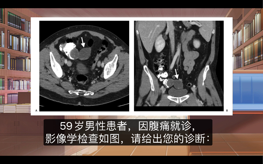 阑尾黏液囊肿,这是一个诊断,但不是一种单纯的疾病哔哩哔哩bilibili