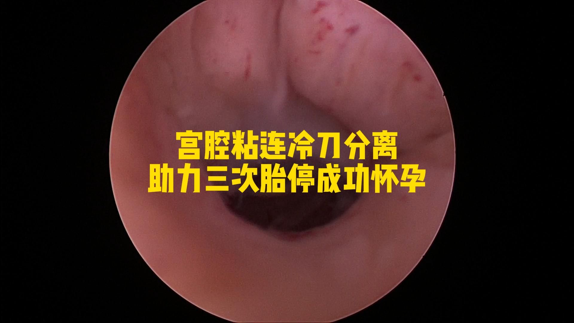 宫腔粘连冷刀分离哔哩哔哩bilibili