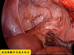 Download Video: 【手术】腹腔镜输尿管下段结石取石