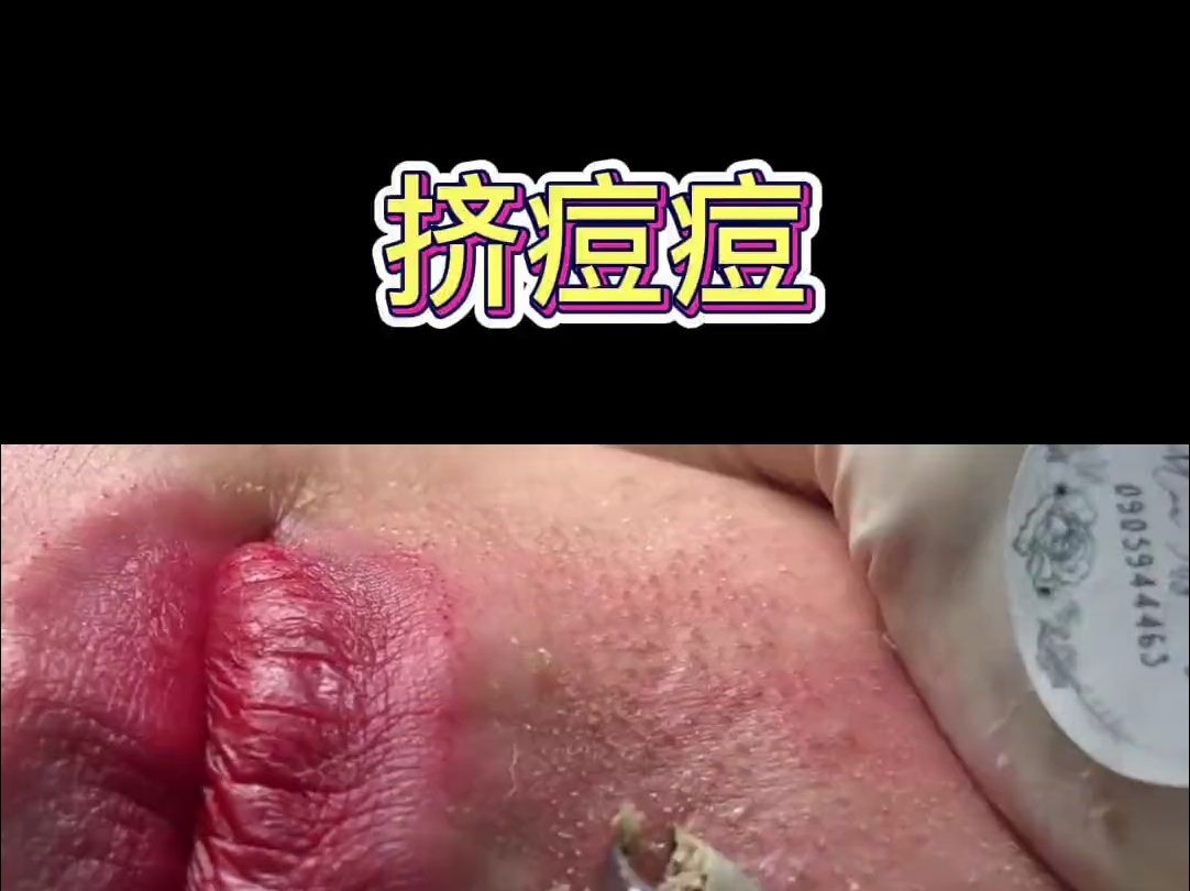 非常轻松愉快的挤痘下饭视频,全程没用手挤,欢迎围观.哔哩哔哩bilibili