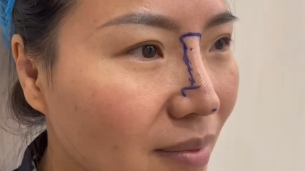 鼻头断层 鼻翼缘缺少"吴付习软糖鼻