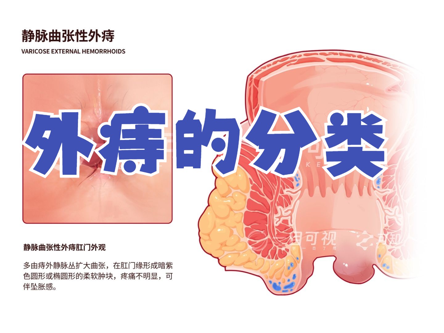 【医学生笔记】外痔的分类?哔哩哔哩bilibili