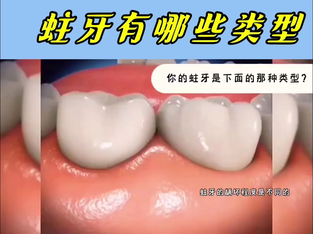15秒了解蛀牙有哪些类型