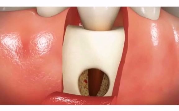 这种慢性根尖周炎,引起的牙齿根尖部肉牙或囊肿,该怎么办呢?一起看看「大连齿医生口腔修复中心」「大连口腔医院」哔哩哔哩bilibili