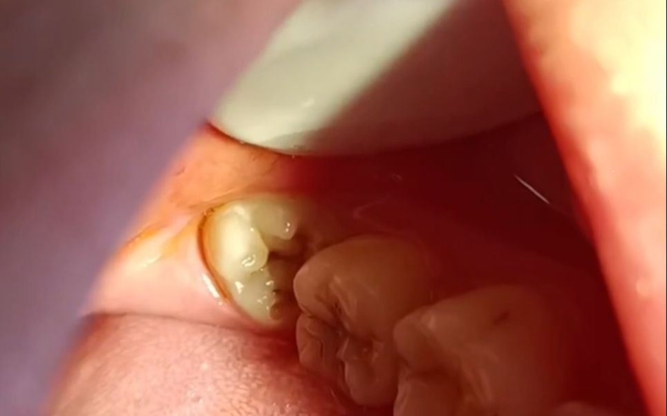 拔智齿疼不疼——南京拔牙,推荐你到南京德牙联合口腔