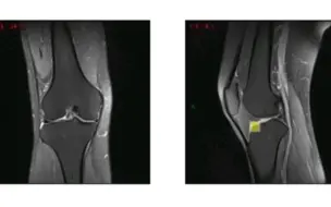 Descargar video: MRI膝关节详细解剖讲解。