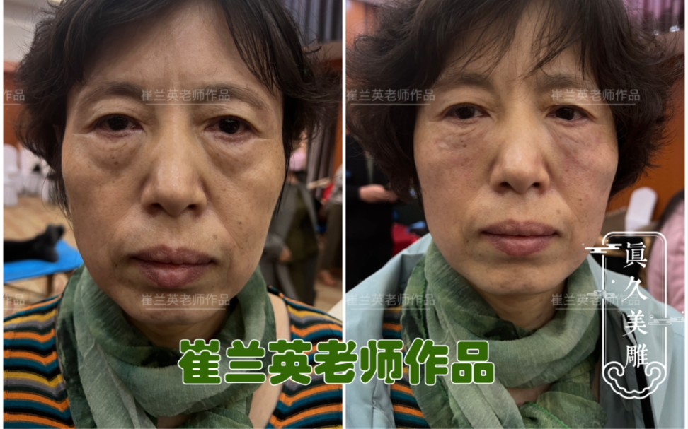 针灸美雕祛眼袋,崔兰英真久美雕