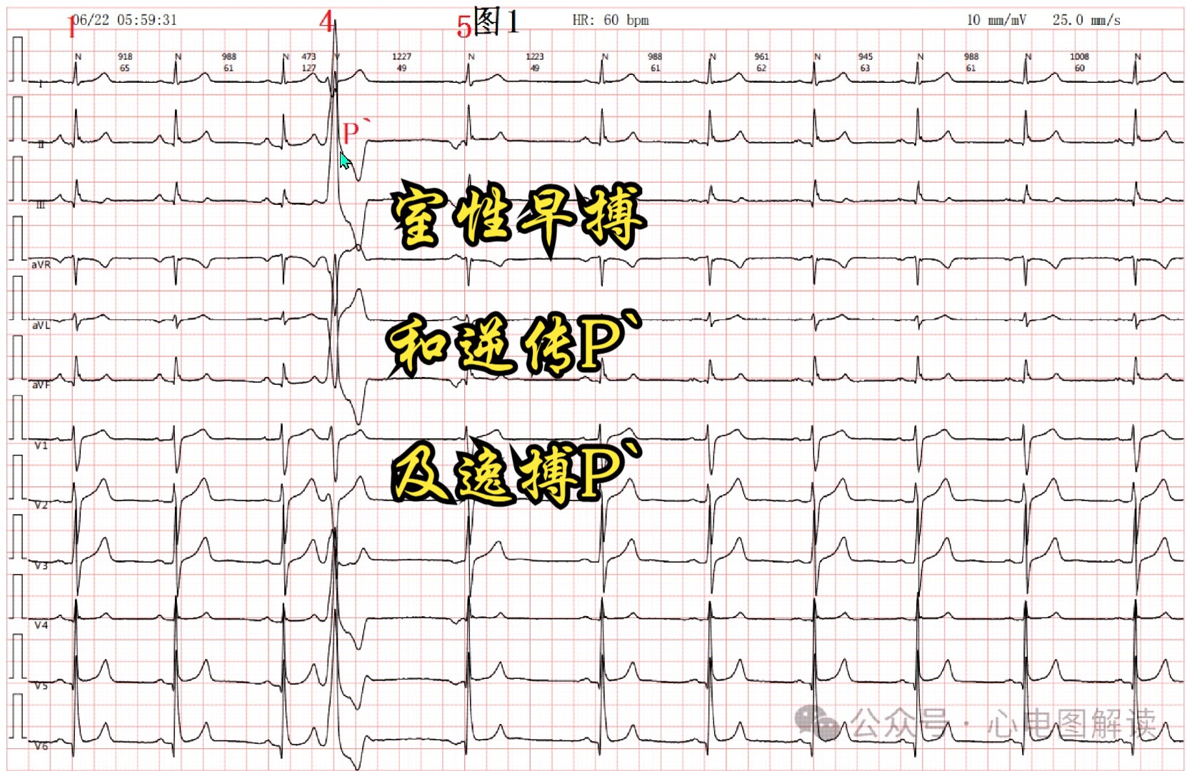 室性早搏和逆传P`及逸搏P`哔哩哔哩bilibili