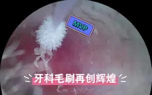 Descargar video: 实在是太感谢推荐我用牙科毛刷掏耳朵的小伙伴了