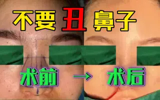 鼻骨矫正 搜索结果 哔哩哔哩 Bilibili