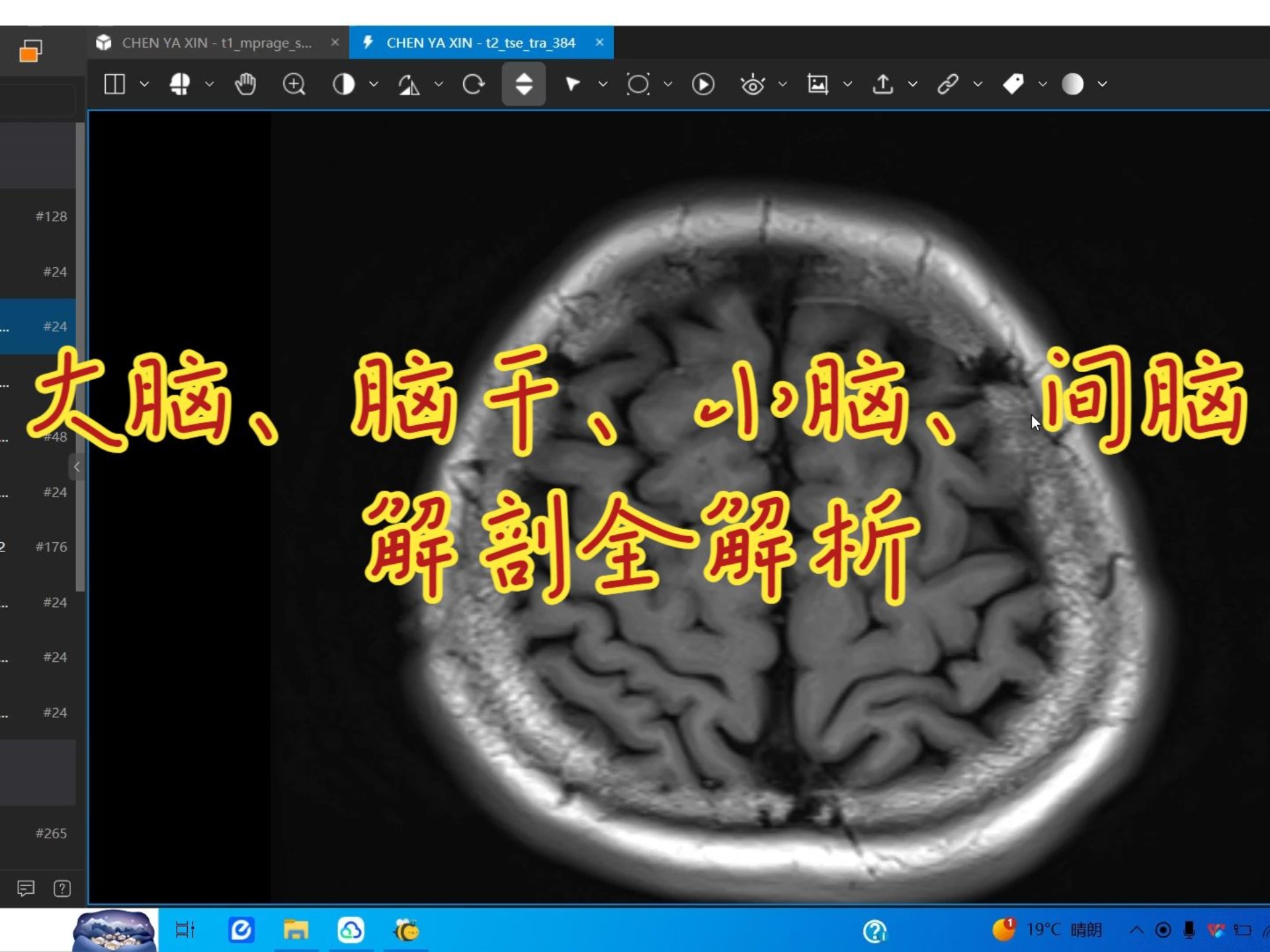 颅脑断层解剖——大脑三沟五叶划分，脑干、小脑、间脑-三口一颗番茄-三口一颗番茄-哔哩哔哩视频
