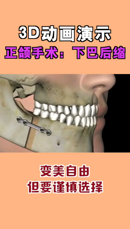 想知道骨性地包天、正鄂是怎么做的?看过来哔哩哔哩bilibili