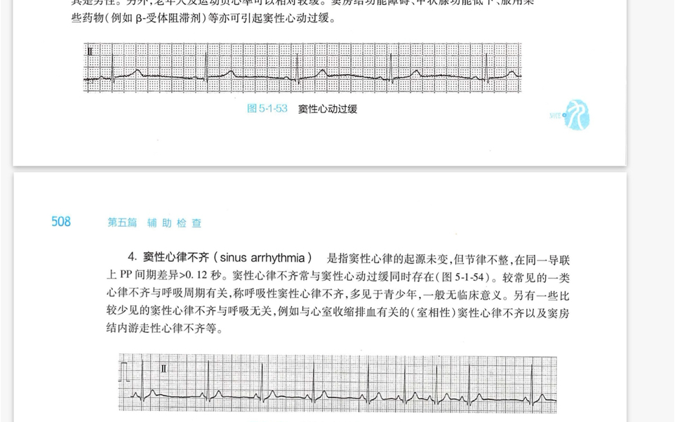 异常心电图之心率失常——早搏、逸搏、房室传导阻滞哔哩哔哩bilibili