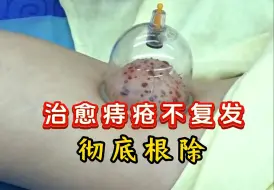 Download Video: 【汉传针雕】治愈痔疮不复发，教你一套针方彻底根除！王瑞雪汉传针雕    美容针灸  私密针灸教学