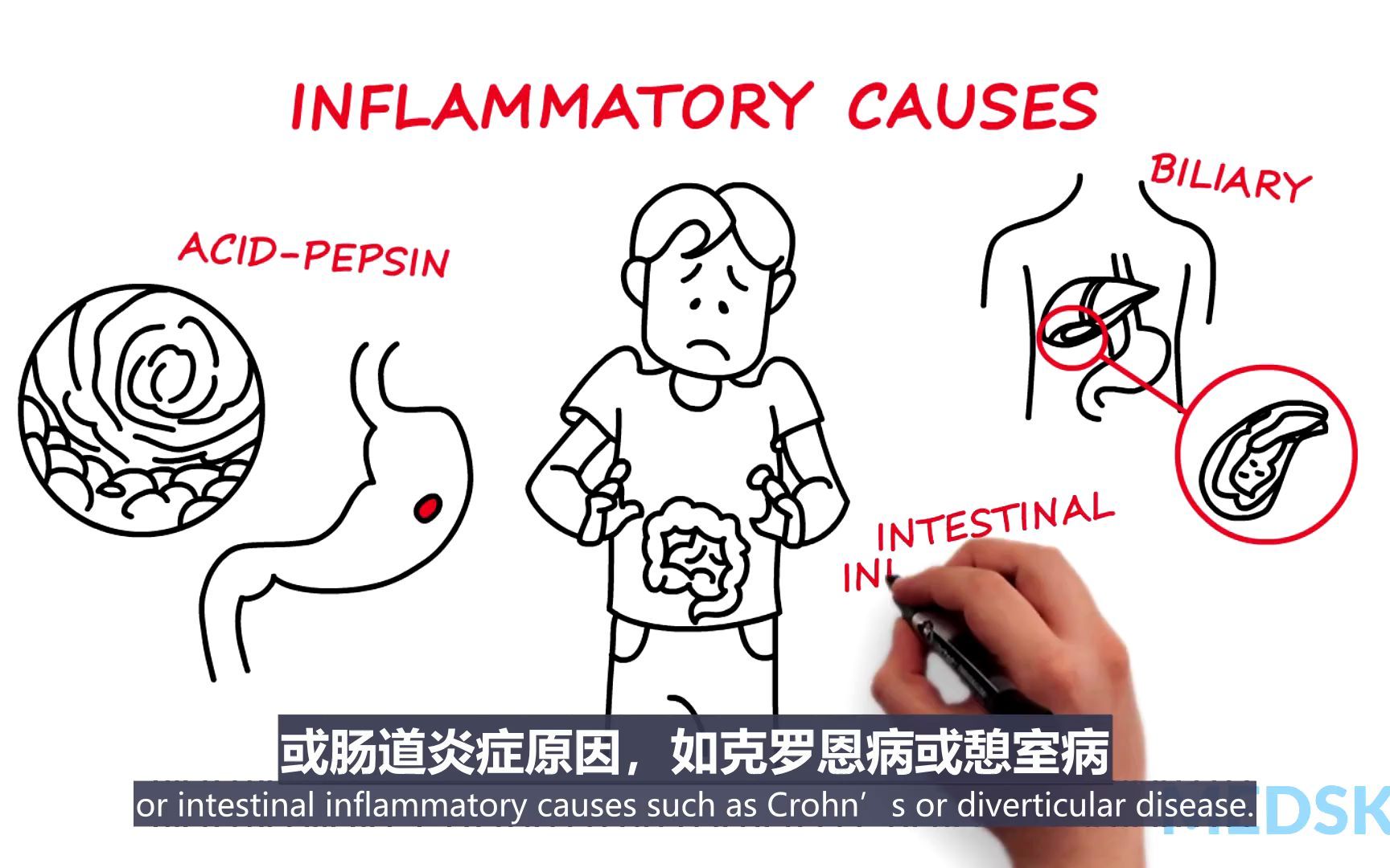 胃肠病学  慢性腹痛哔哩哔哩bilibili