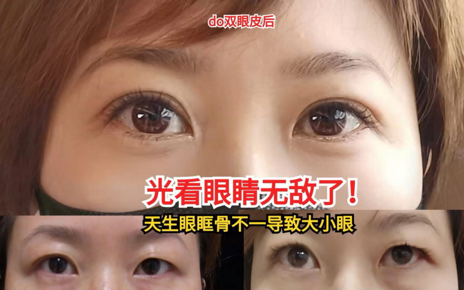 天生眼眶骨大小不一导致大小眼,去do双眼皮手术了,竟改头换眼!