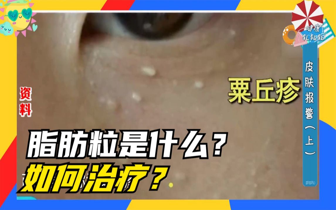 眼睛周边的脂肪粒是什么?如何去除?哔哩哔哩bilibili