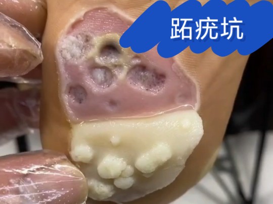 跖疣拔完留下一片陨石坑