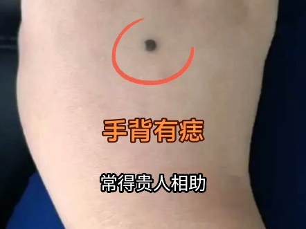 手背有痣
