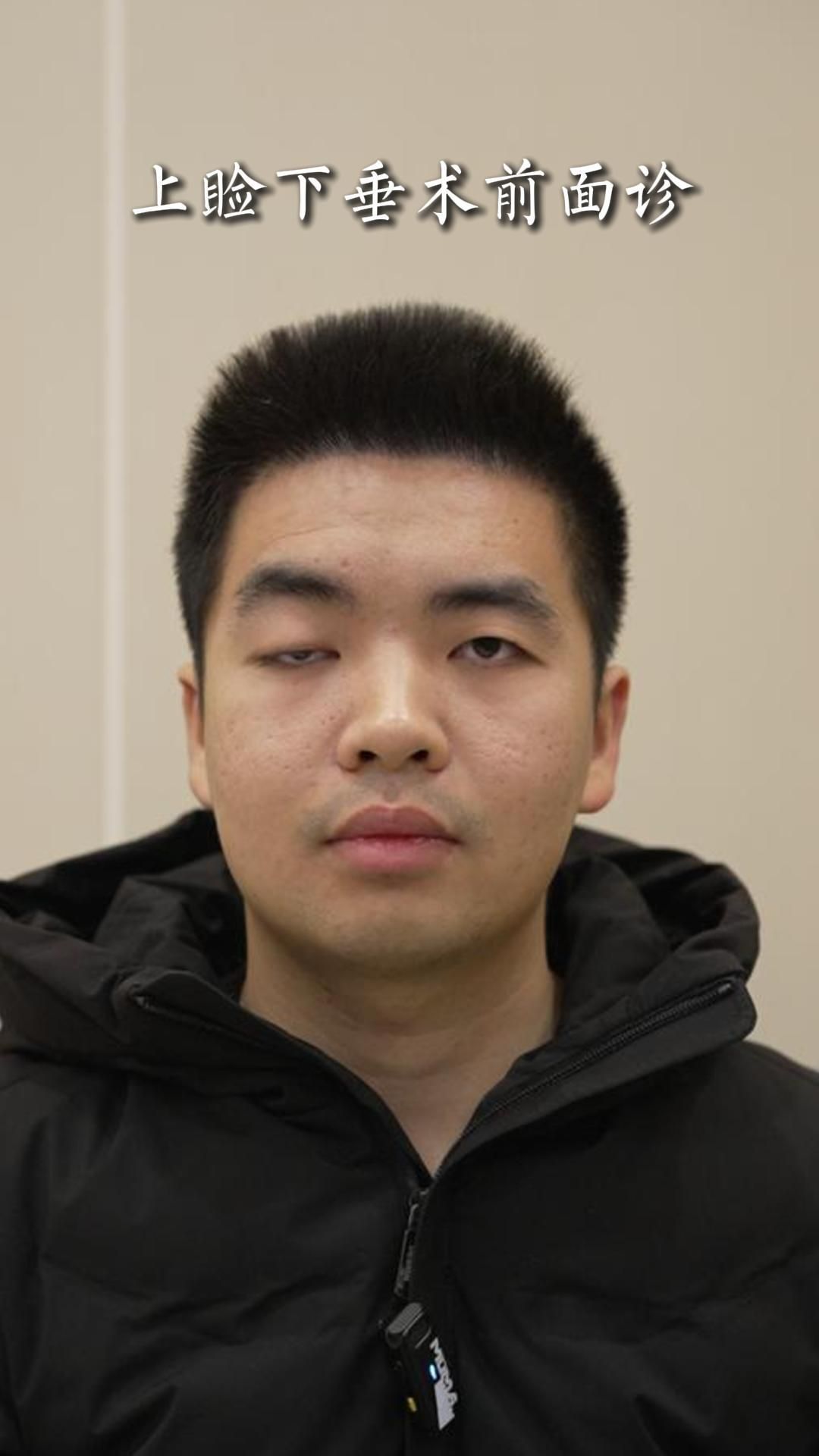 重度上睑下垂,术前面诊