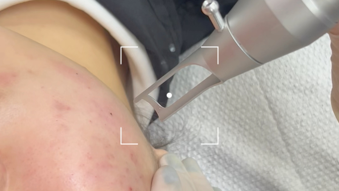 超皮秒全脸扫黄,祛痘印,促进皮肤代谢,激活胶原蛋白再生