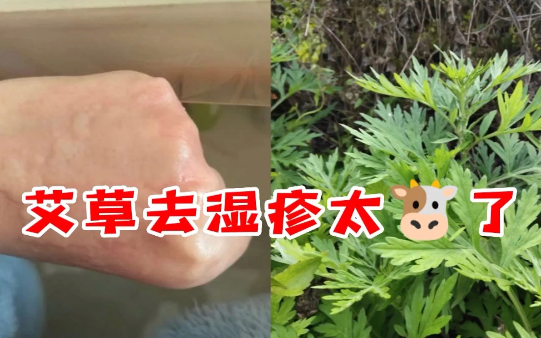 艾草去湿疹真的太牛了,湿疹全都断根不再长了哔哩哔哩bilibili